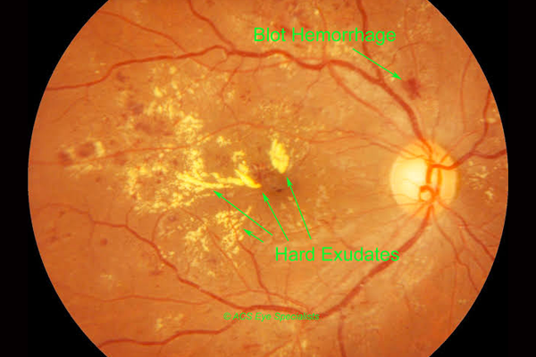 Ophthalmologist-in-Thane